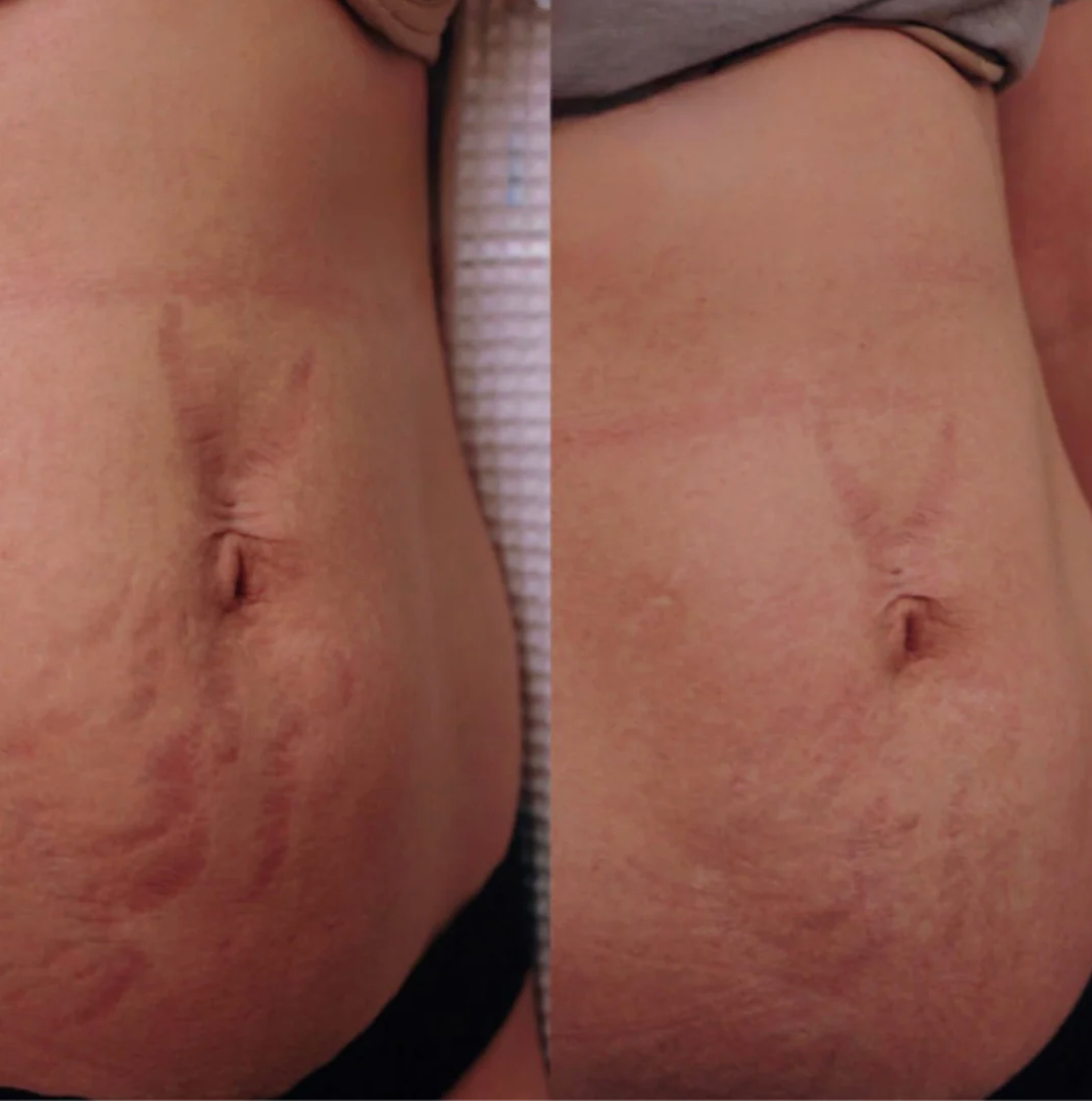 ThermaLight360™ - Pain Relief & Slimming Belt + Red Light Mastery Guide